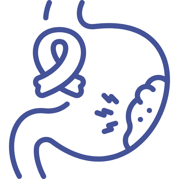 Cáncer de estómago